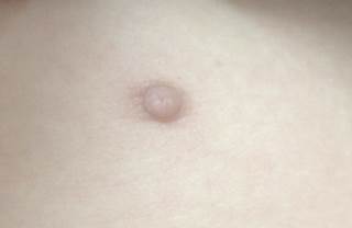 Moles May Indicate Breast Cancer Risk Moles May Indicate Breast Cancer Risk