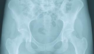 Which Options Are Best for Pelvic Congestion Syndrome?