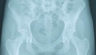 Which Options Are Best for Pelvic Congestion Syndrome? Which Options Are Best for Pelvic Congestion Syndrome?