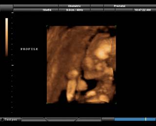 "Keepsake" Fetal Imaging May Do More Harm Than Good, FDA Warns "Keepsake" Fetal Imaging May Do More Harm Than Good, FDA Warns