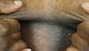Clinical Challenge: Warty Papules on the Chest, Ears Clinical Challenge: Warty Papules on the Chest, Ears
