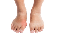... May Have Similar Analgesic Efficacy for Acute Gout as Current Rx - MPR