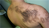 Clinical Challenge: Coarse Hairs on the Back, Shoulder Clinical Challenge: Coarse Hairs on the Back, Shoulder