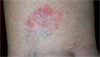 Clinical Challenge: Erythematous, Raised Plaque on Calf Clinical Challenge: Erythematous, Raised Plaque on Calf
