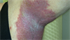 Clinical Challenge: Long-Term, Recurring Rash in Axillae, Groin Folds Clinical Challenge: Long-Term, Recurring Rash in Axillae, Groin Folds