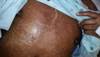 Clinical Challenge: Desquamating Full-Body Rash in HIV-Positive Patient Clinical Challenge: Desquamating Full-Body Rash in HIV-Positive Patient