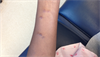 Clinical Challenge: Purplish Bumps on the Forearm Clinical Challenge: Purplish Bumps on the Forearm