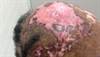 Clinical Challenge: Progressive Hair Loss With Scarring Clinical Challenge: Progressive Hair Loss With Scarring
