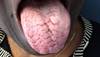 Clinical Challenge: "Funny Tongue" in Patient Clinical Challenge: "Funny Tongue" in Patient