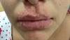 Clinical Challenge: Itchy Lesions Around the Lips Clinical Challenge: Itchy Lesions Around the Lips