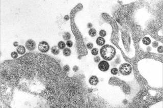 Lassa Fever Death Confirmed in N.J. Man Lassa Fever Death Confirmed in N.J. Man