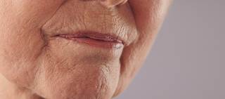 Safety and efficacy of Juvederm Volbella XC was demonstrated in a trial of 168 people Safety and efficacy of Juvederm Volbella XC was demonstrated in a trial of 168 people