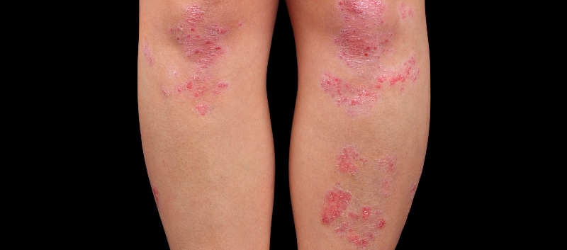 Secukinumab Efficacy Assessed in Psoriatic Arthritis - ONA Secukinumab Efficacy Assessed in Psoriatic Arthritis - ONA