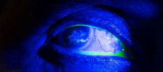 Corneal epithelial changes can be caused by medications in multiple pharmacologic classes Corneal epithelial changes can be caused by medications in multiple pharmacologic classes