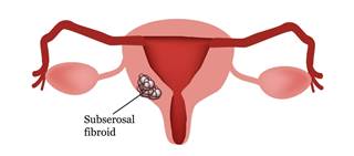 From 2012 through 2013, hysterectomies were performed 65 times more often than embolization From 2012 through 2013, hysterectomies were performed 65 times more often than embolization