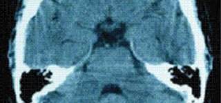 Children With Mild TBI Exhibit White Matter Abnormalities Children With Mild TBI Exhibit White Matter Abnormalities