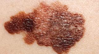 New Treatments for Advanced Melanoma New Treatments for Advanced Melanoma