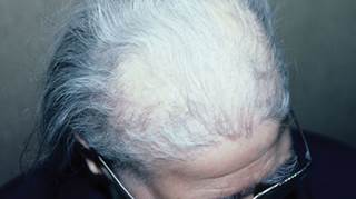Causes of Thinning Hair in a Postmenopausal Woman Causes of Thinning Hair in a Postmenopausal Woman