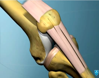 Those who experience knee buckling are at increased risk of recurrent falls Those who experience knee buckling are at increased risk of recurrent falls