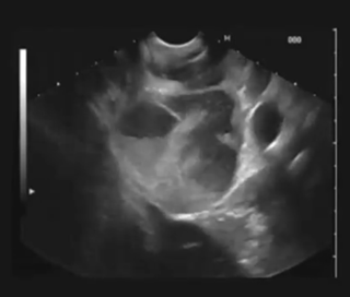 Guidelines developed for management of upper gastrointestinal foreign body ingestion Guidelines developed for management of upper gastrointestinal foreign body ingestion