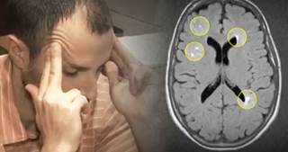 Lesions in White Matter, Migraines Lesions in White Matter, Migraines