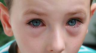 Symptoms of Spring: Treating Rhinitis and Allergic Conjunctivitis Symptoms of Spring: Treating Rhinitis and Allergic Conjunctivitis