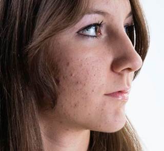 Topical Retinoids for Adult Acne Often Underused with Antibiotic Courses Topical Retinoids for Adult Acne Often Underused with Antibiotic Courses