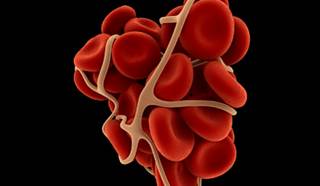 Initiation of Biologic DMARDs Associated with Increased VTE Risk Initiation of Biologic DMARDs Associated with Increased VTE Risk
