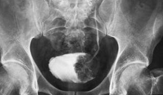 Bladder Cancer Study Unveils New Potential Targeted Therapies Bladder Cancer Study Unveils New Potential Targeted Therapies