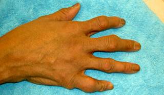 Gout Management ?in Patients With Chronic Kidney Disease Gout Management ?in Patients With Chronic Kidney Disease