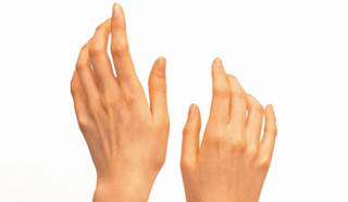 Case report describes 60-year-old man with tremors and episodes of buccal dyskinesia, dysgraphia Case report describes 60-year-old man with tremors and episodes of buccal dyskinesia, dysgraphia