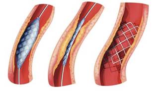 New Study to Review Ticagrelor Monotherapy Post-PCI New Study to Review Ticagrelor Monotherapy Post-PCI