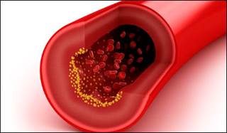New ACC/AHA Guidelines -- Part Three: Controversies Surrounding New Cholesterol Guidelines New ACC/AHA Guidelines -- Part Three: Controversies Surrounding New Cholesterol Guidelines