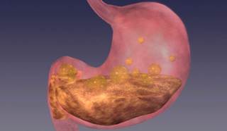 New Possible Target Against Gastric Injury Studied New Possible Target Against Gastric Injury Studied