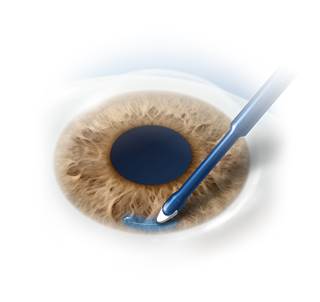 ReSure Sealant by Ocular Therapeutix ReSure Sealant by Ocular Therapeutix