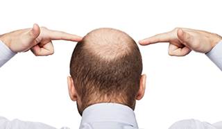 Baldness May Spell Trouble for the Heart Baldness May Spell Trouble for the Heart