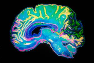 Why Higher BP May Protect Against Alzheimer's Risk Why Higher BP May Protect Against Alzheimer's Risk