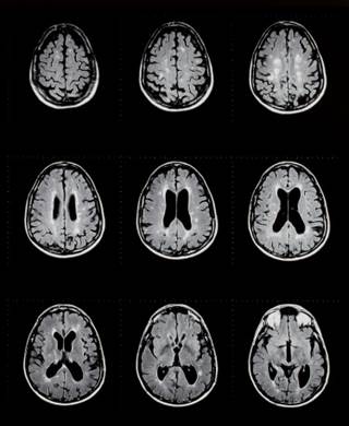 Additional Support for Toxin as MS Trigger Additional Support for Toxin as MS Trigger