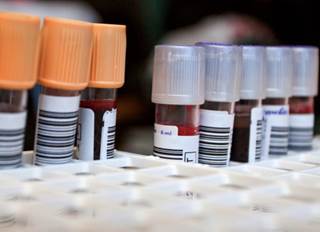 New Blood Test May Be Safer Way to Detect Food Allergies New Blood Test May Be Safer Way to Detect Food Allergies