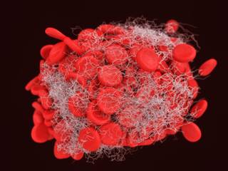 Monitoring Direct Thrombin Inhibitors: aPTT or Alternative? Monitoring Direct Thrombin Inhibitors: aPTT or Alternative?