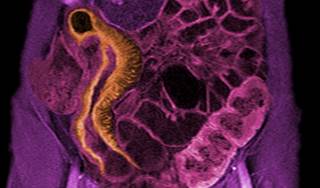 Crohn's Disease: Does it Increase Cancer Risk? Crohn's Disease: Does it Increase Cancer Risk?