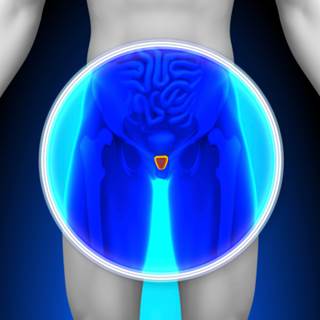 Prostatectomy Cuts Mortality in Early Prostate Cancer Prostatectomy Cuts Mortality in Early Prostate Cancer
