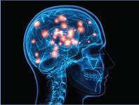 New MS Tx Could Offer Neuroprotection for MS Patients New MS Tx Could Offer Neuroprotection for MS Patients