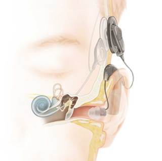 First Implantable Device for High-Frequency Hearing Loss First Implantable Device for High-Frequency Hearing Loss