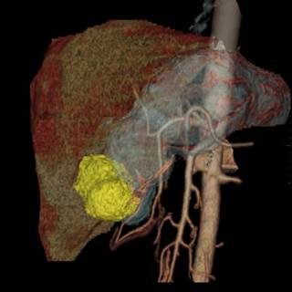 Treatment Options for Gastrointestinal Stromal Tumors Treatment Options for Gastrointestinal Stromal Tumors