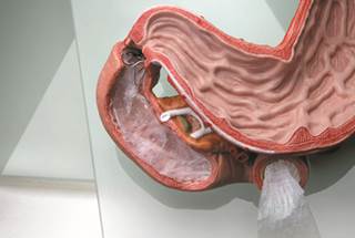 EndoBarrier Device Significantly Reduced HbA1c, Weight EndoBarrier Device Significantly Reduced HbA1c, Weight