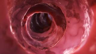 Mutations linked to shorter survival in patients with microsatellite-stable tumors Mutations linked to shorter survival in patients with microsatellite-stable tumors
