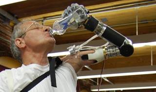 First-of-Kind Prosthetic Arm First-of-Kind Prosthetic Arm