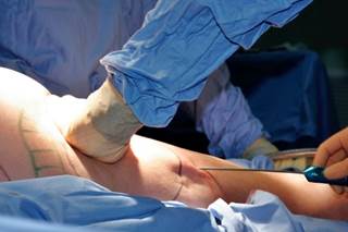 Strep Outbreak Associated with Liposuction Surgery Strep Outbreak Associated with Liposuction Surgery