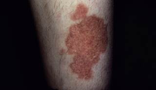 Spreading Rash on Shin: What Does it Signify? Spreading Rash on Shin: What Does it Signify?